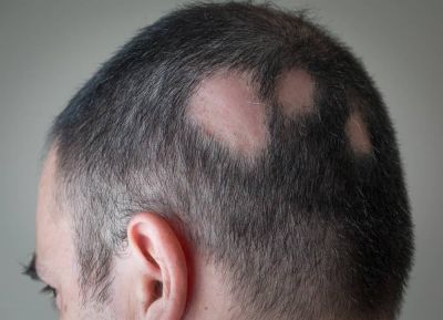 ریزش مو سکه ای و روشهای درمان آن
