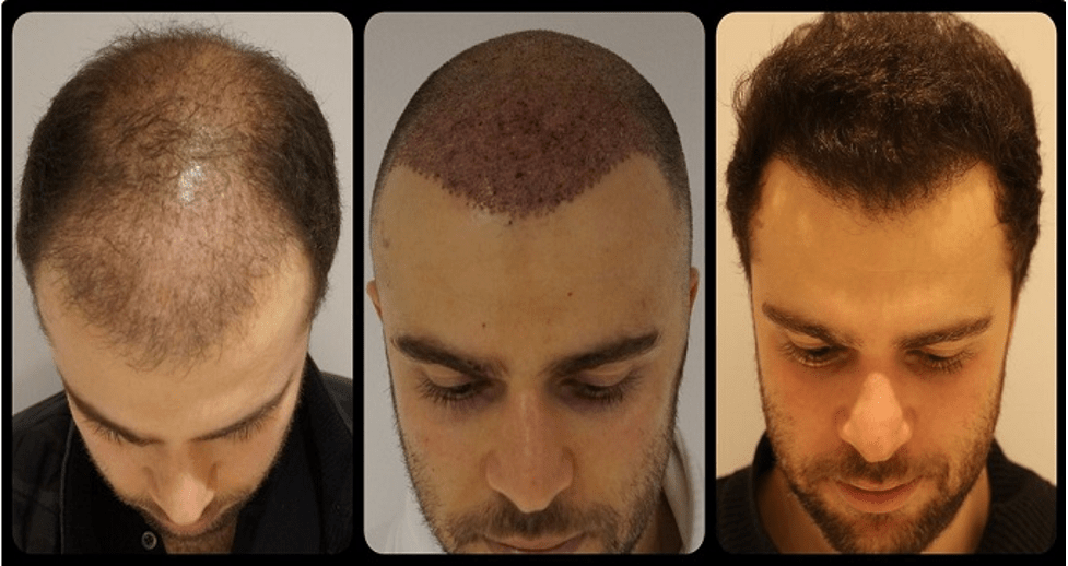 کاشت مو با استفاده از روش MICRO FIT