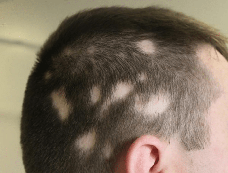 برای درمان ریزش مو سکه ای چه اقداماتی لازم است؟